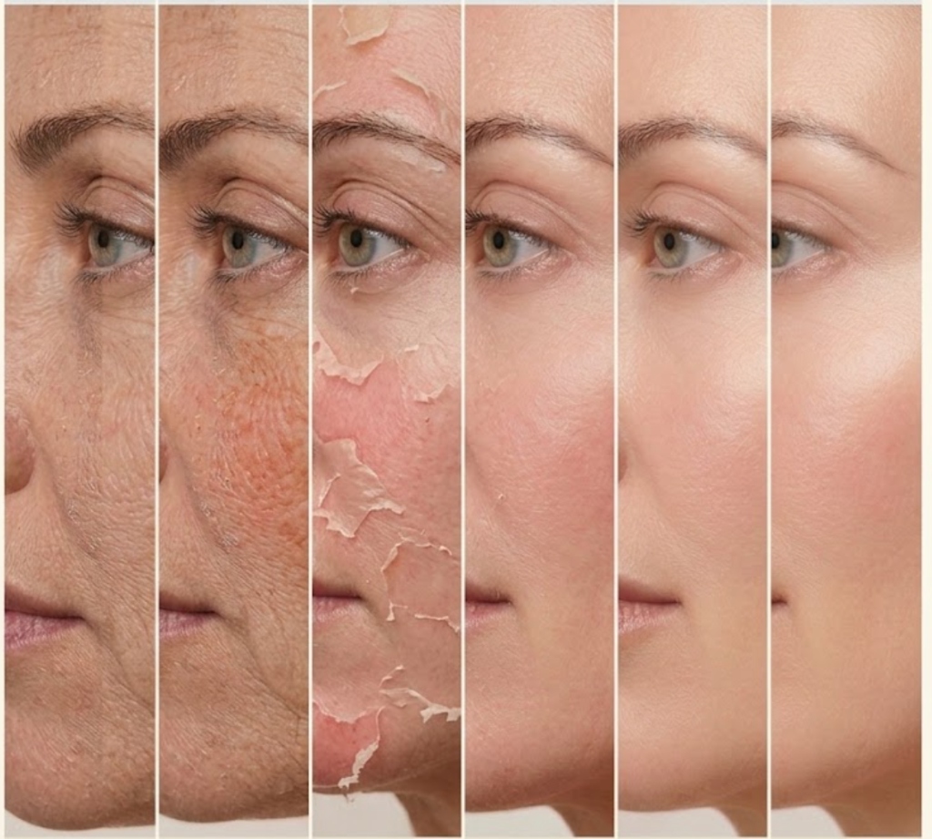 Chemical peel treatment at Mila Beauty Injections