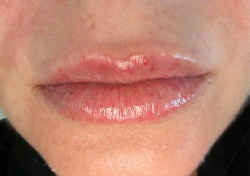 Dermal filler treatment consultation at Mila Beauty Injections