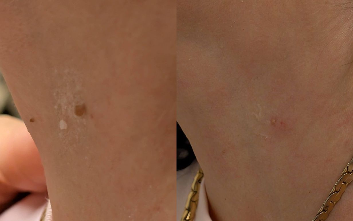 Skin tag removal consultation in Los Gatos