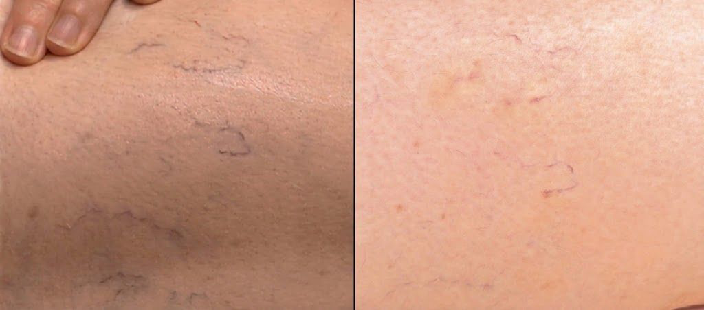 Spider vein treatment consultation at Mila Beauty Injections